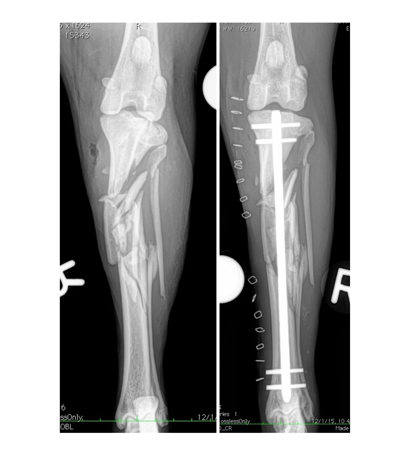 Comminuted-Tibia-fracture-pre-and-postop-AP
