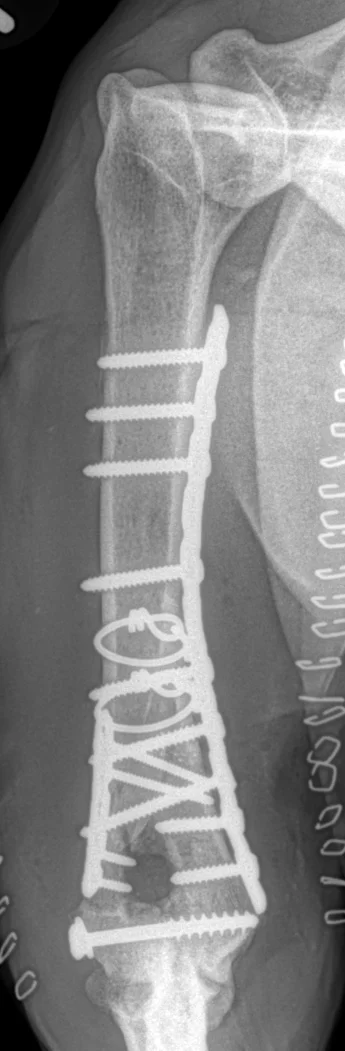 Distal-humerus-T-Y-fracture-postop-AP-xray