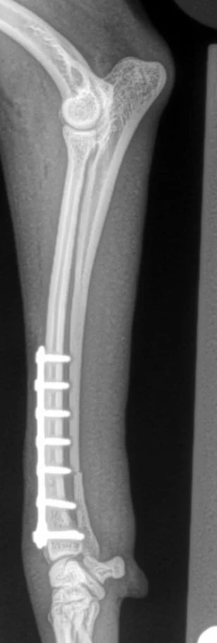 Distal-radius_ulna-fracture-postop-lateral-xray