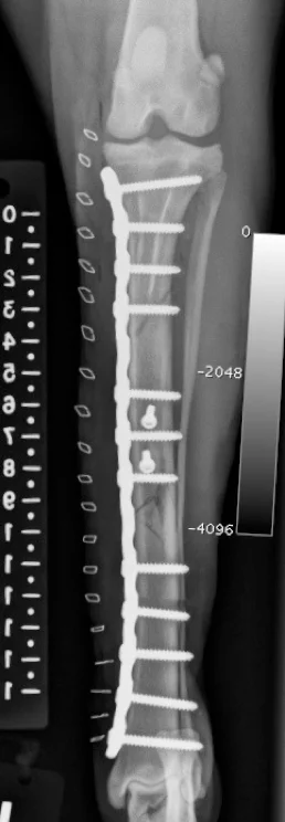 Tibia-fracture-neutralization-plate-2
